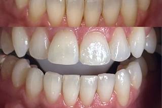 Illuma Teeth Whitening - 3