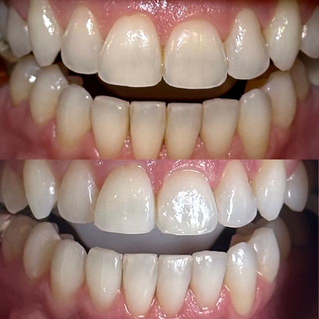 Illuma Teeth Whitening - 1