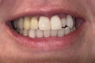 Maui Whitening SETX - 1