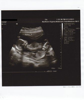 BR: 15 week belly pic and twin ultrasound