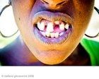 N E of u ALL got a messed up GRILL liek me?! (pix of me includeed)