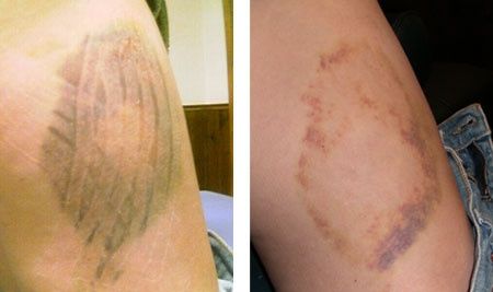Broken bones 9 days before wedding. *update & BAM on pg 3*