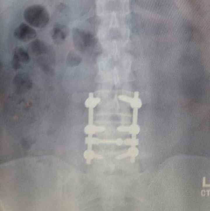NWR: Spinal Fusion