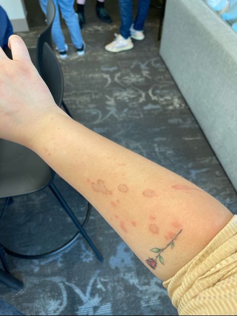 How can i get rid of scars?? 1