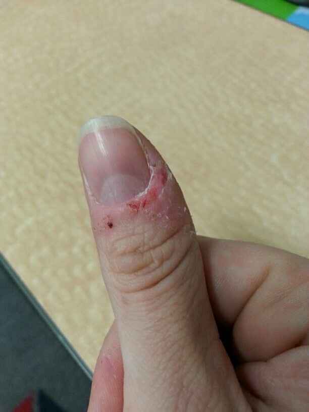 Wedding Manicures and Dermatillomania