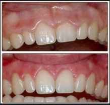 NWR: Gingival Recontouring?