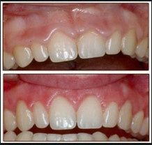 NWR: Gingival Recontouring?