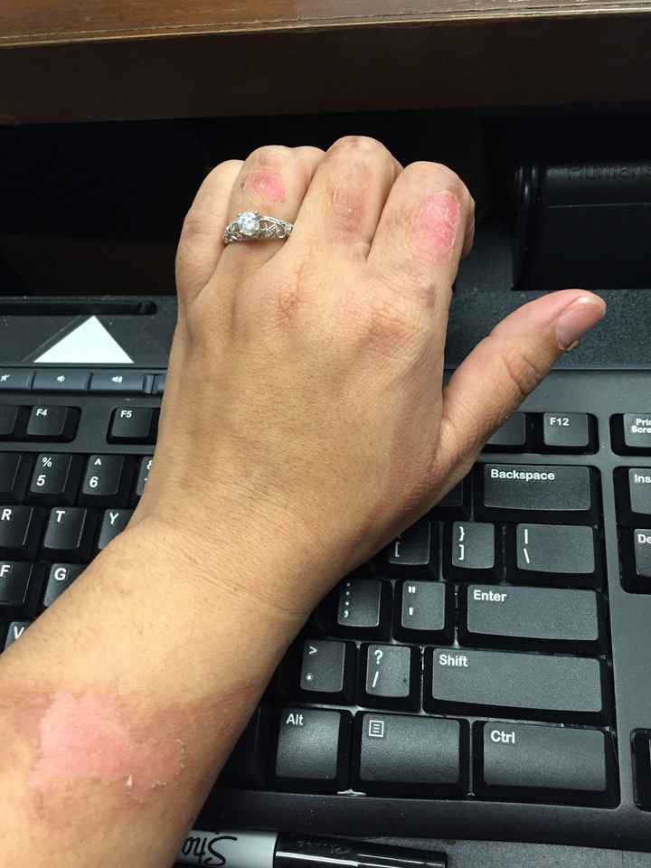 Worried About Scar on My Ring Finger :(