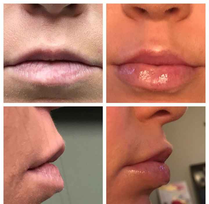  Lip Injections.... - 1