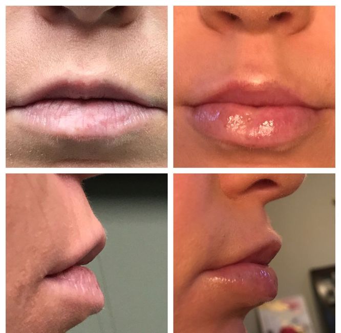  Lip Injections.... - 1