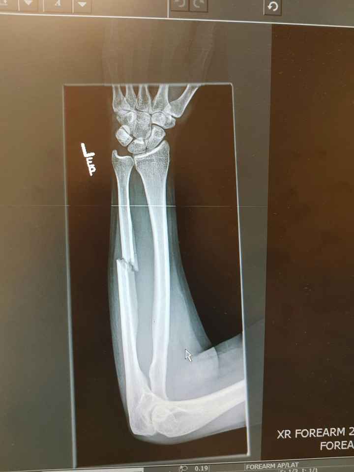 Broken bones 9 days before wedding. *update & BAM on pg 3*