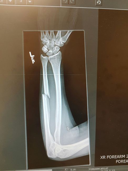 Broken bones 9 days before wedding. *update & BAM on pg 3*