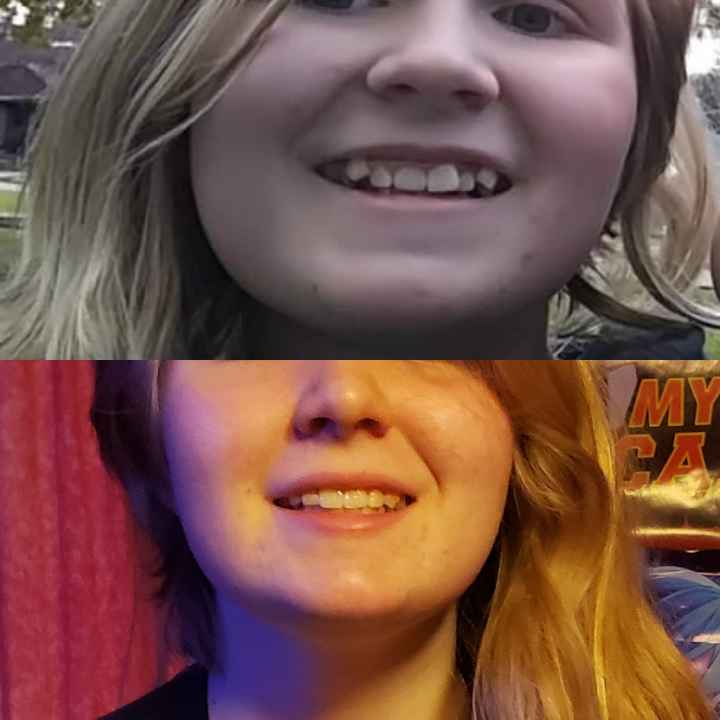 Invisalign - 1
