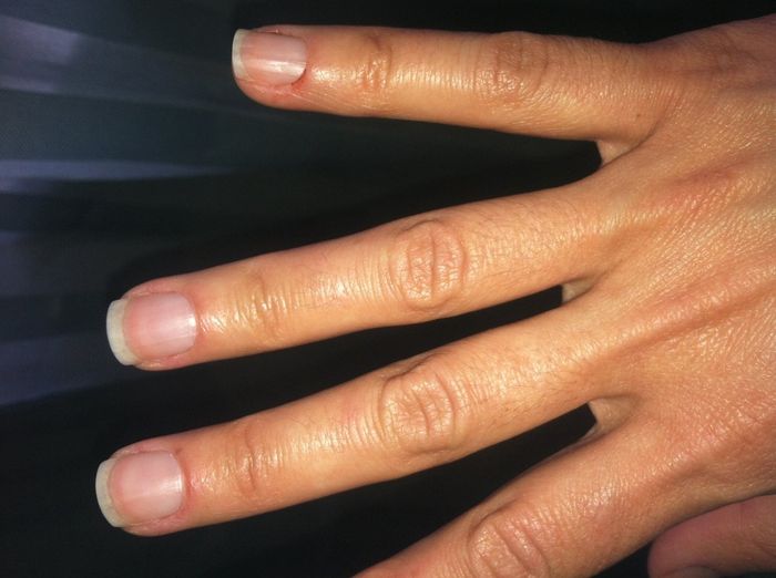 Left sprained Ring Finger