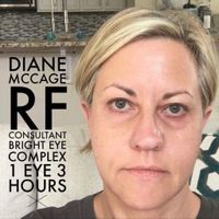 Bright eye complex before and after