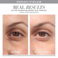 Bright eye complex before and after