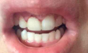 NWR: Gingival Recontouring?