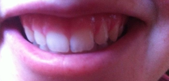 NWR: Gingival Recontouring?