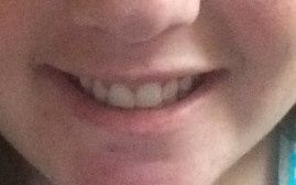 NWR: Gingival Recontouring?