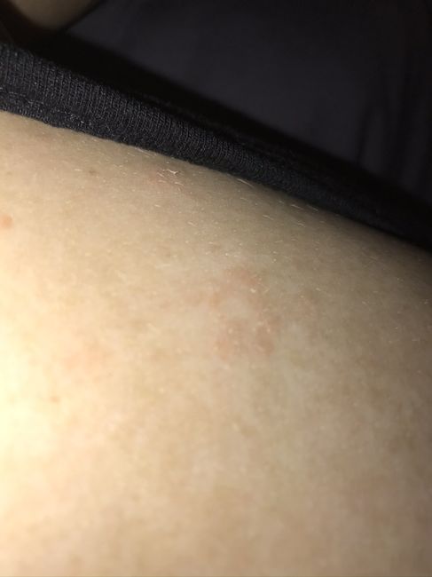 Stress breakouts or rashes? Venting. - 2