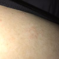 Stress breakouts or rashes? Venting. - 2