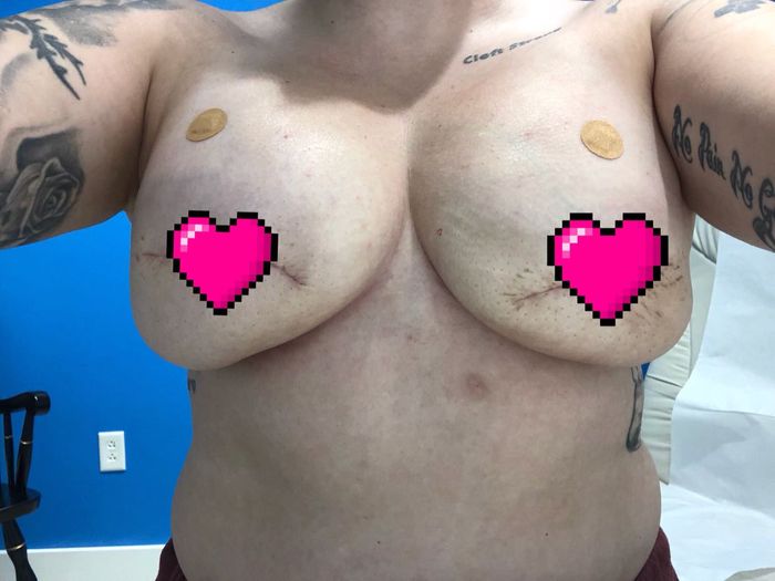  7 Months Out and No Dress...breast Cancer - 1