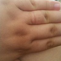 Lump under my engagement ring