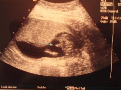 BR: monthly baby/pregnancy update thread!