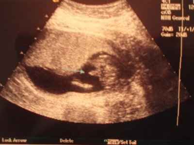 BR: monthly baby/pregnancy update thread!