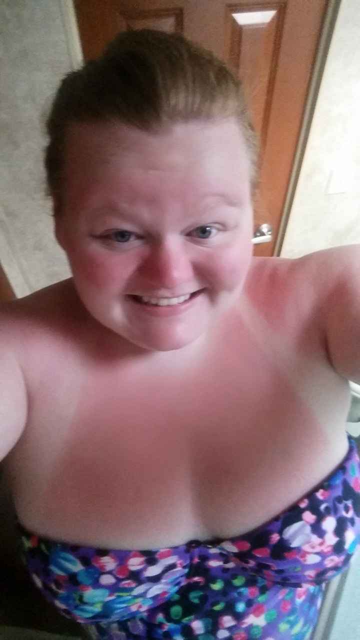 Nwr everyone remember that horrible sunburn I got