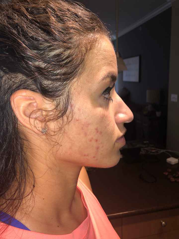acne !!!!!!! - 1