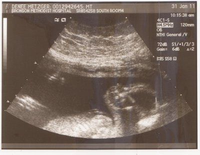 Ultrasound-the verdict is in!