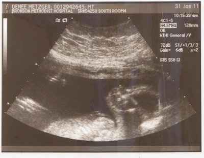 Ultrasound-the verdict is in!