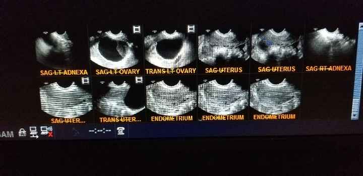 Ovarian cyst is trying to ruin the wedding and honeymoon. Sad. - 1