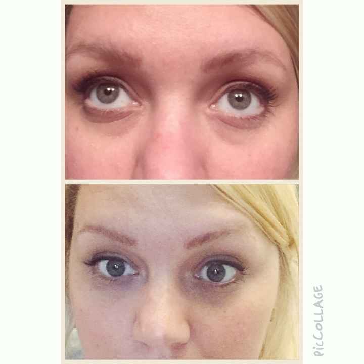 Anyone else struggle with eye bags? **Update with pic after juenesse trial