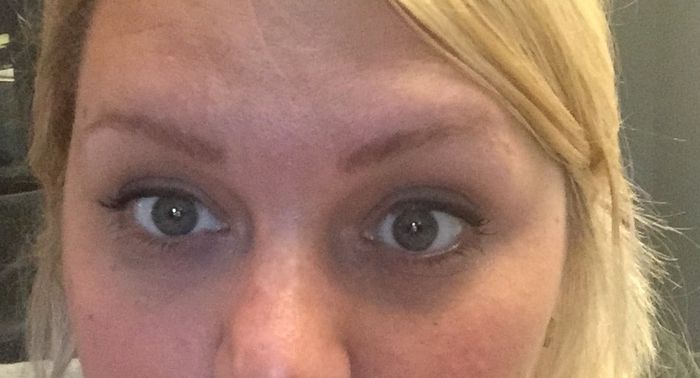 Anyone else struggle with eye bags? **Update with pic after juenesse trial