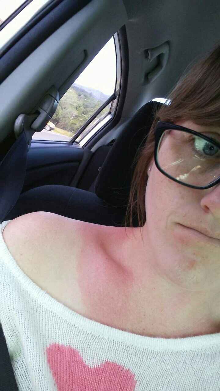 Sunburn before wedding...Help!