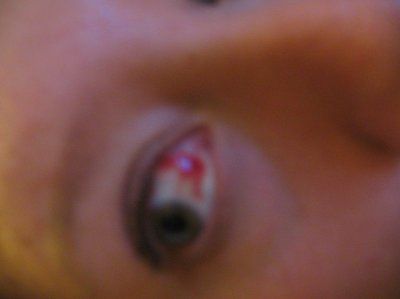 OMG! Someone help me! I have a nasty freak eye! (NWR)
