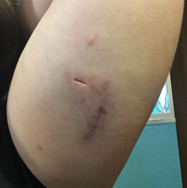 NWR: Birth Control options, arm implant, IUD, other options/input? Possibly TMI/Sensitive