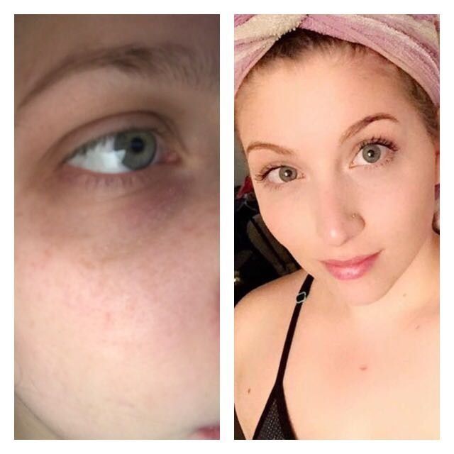 Dark circles around my eyes - Help!!!!
