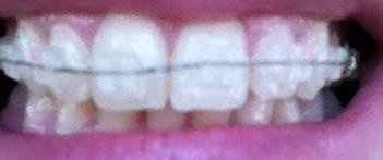 *UPDATE* Freaking out, people with braces or had them HELP!