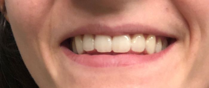 Teeth Whitening 2
