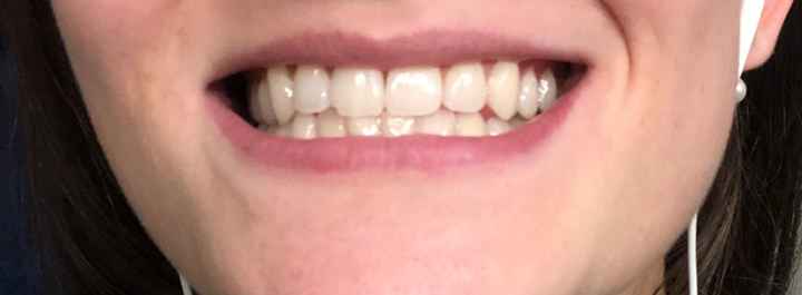 Whitening - 2
