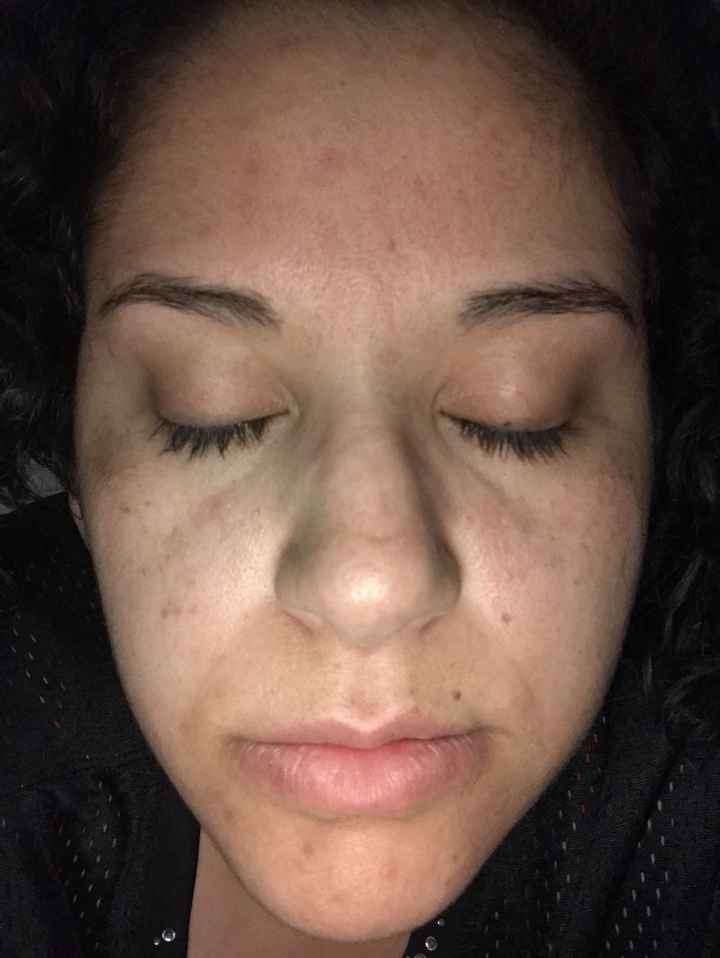 Acne scars, blemishes, etc - 1