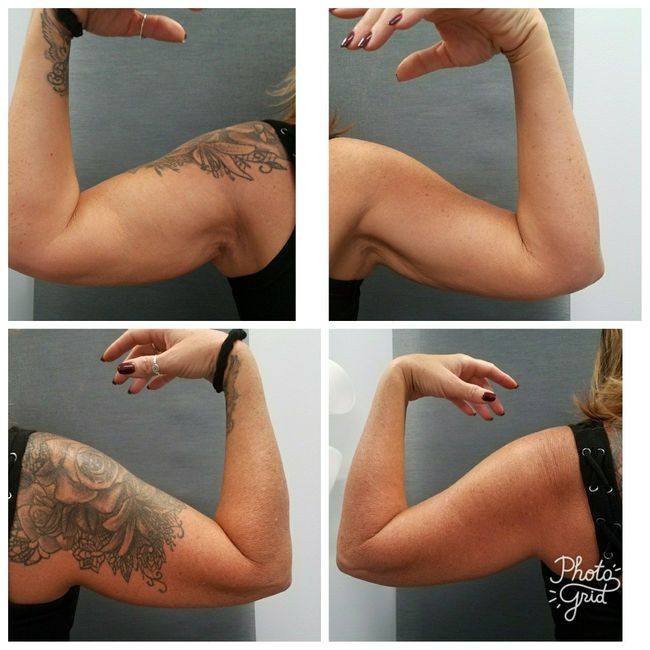 KWR: COOL SCULPTING.... I'm doin it- has anyone else??