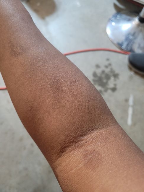 How can i get rid of scars?? 2