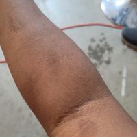 How can i get rid of scars?? - 1