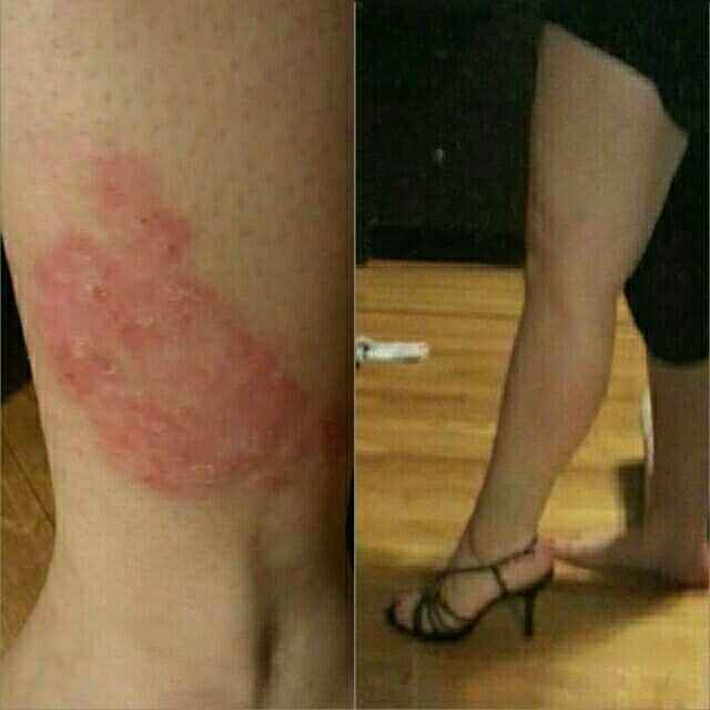 NWR: Psoriasis