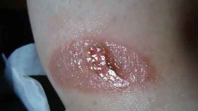 NWR  This is why you always wear pants on a motorcyle!