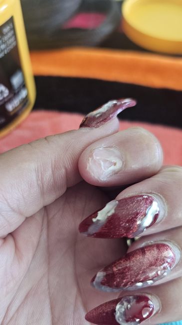 My Finger Nail Fell Off 1 Month Before my Wedding!!! - 4